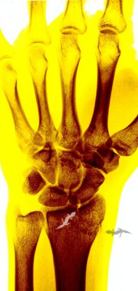 Fracture humérus