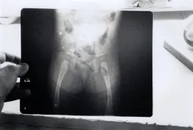 Malformations congéntales