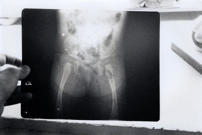 Malformation congénitale
