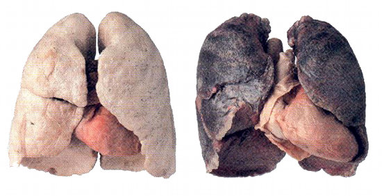 Poumon: sain contre fumeur
